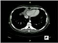 CT Scan of Abdomen