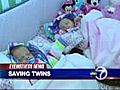 Unborn twins face life-threatening abnormality