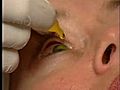 [Video] New eye drop may replace cornea transplant