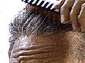 Saç ekimi işlemi kimlere uygulanabilir?