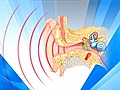 Preventing Infant Hearing Loss