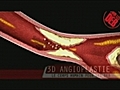 Observez de près une angioplastie