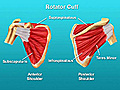 Shoulder Surgery: Rotator Cuff