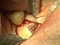 Fractured Implant Extraction