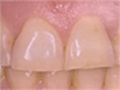 Acid Wear and Your Teeth