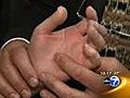 Healthbeat Report: Help for Cold Hands