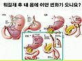 연세의대 외과학교실 노성훈 교수 - 위암의 예방과 최신 치료법 - 02