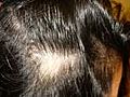 La pérdida de pelo debido a la alopecia