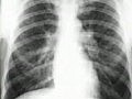 Chest X-Ray Interpretation - Sarcoidosis