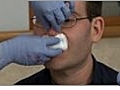 How to Treat a Bleeding Nose