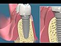 Consult-Pro Dental Patient Education Videos