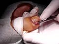 Ingrown Toenail Surgery