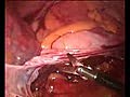 Laparoscopic Colon Resection