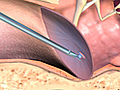 Ear Tubes and Tympanostomy