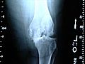 [Video] New Signature knee replacement surgery