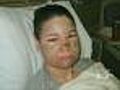 Woman Badly Burned In Random Acid Attack