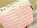Atrial Fibrillation: an irregular or rapid heartbeat