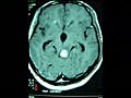 Pineal Tumorchirurgie