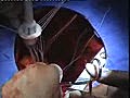 Mitral Valve Replacement Surgery