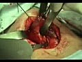 Thyroidectomy