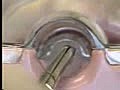 Intra-Uterine Device IUD Removal
