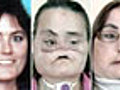 First US Face Transplant Patient