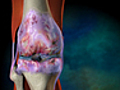 What Is Osteoarthritis?