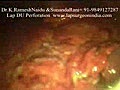 Laparoscopy DU Perforation Closure Video (Lap...