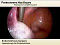 Laparoscopic Endometriosis Surgery