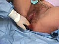 Midline Episiotomy