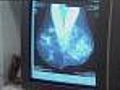 Awareness Alert: New treatments for breast cancer