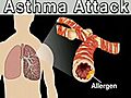 The Real Deal with Asthma Attacks