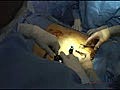 Laparoscopic Sleeve Gastrectomy