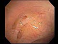 Diverticulosis