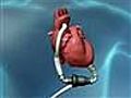 Permanent heart pump aids survival