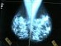 Mammograms Could Increase the Risk for Breast Cancer