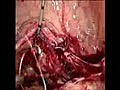 Laparascopic Vesicovaginal Fistula Repair