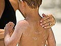 How to protect your child from sunburn