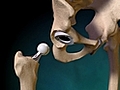 What Happens During Hip Replacement Surgery?