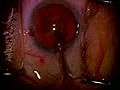 Cataract Surgery 4