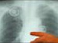 Saving Lives: Detecting Lung Cancer Faster