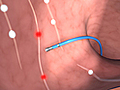 How Radiofrequency Ablation Works