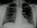 Chest x-ray &#8212; Histoplasmosis