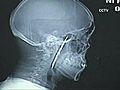 Blade Stuck In Man’s Head For 4 Years