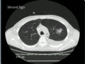 Chest --CT scan Monod Sign