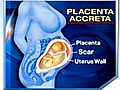 Placenta Accreta: Dangers of Multiple C-Sections