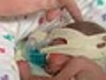 Lifelong risks of premature birth