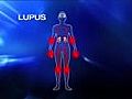 Revolutionary drug to fight lupus