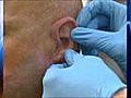 Soldier receives prosthetic ear