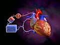 Off-Pump Coronary Artery Bypass Surgery